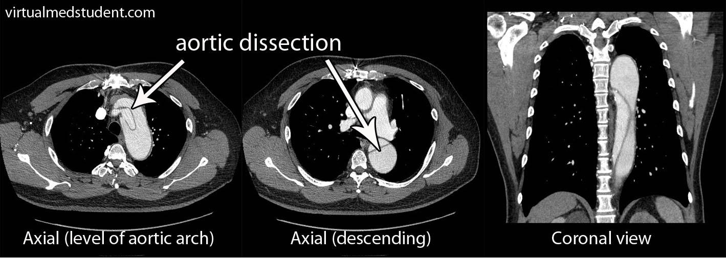 Aortic Dissection