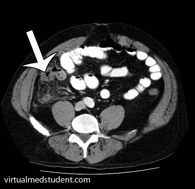 Appendicitis