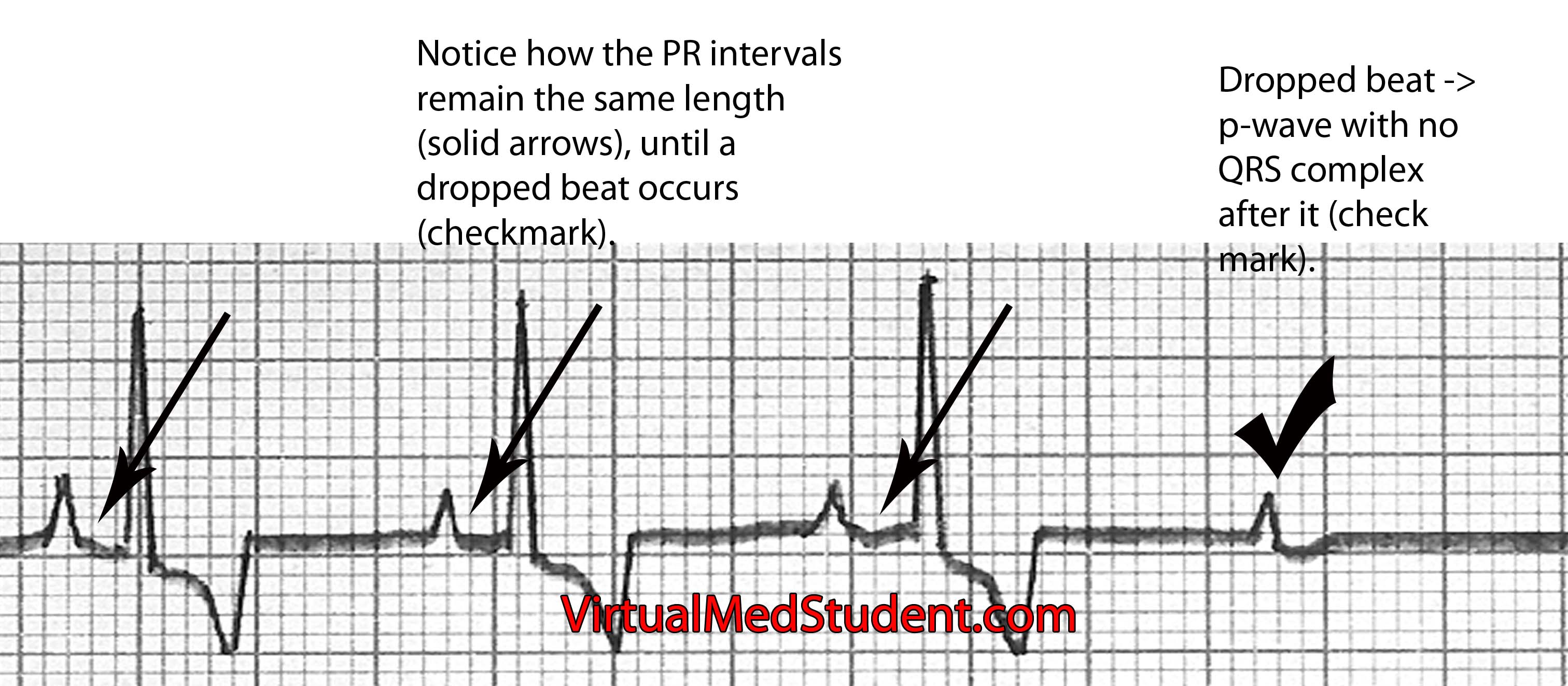 AV Nodal Block (Heart Block)