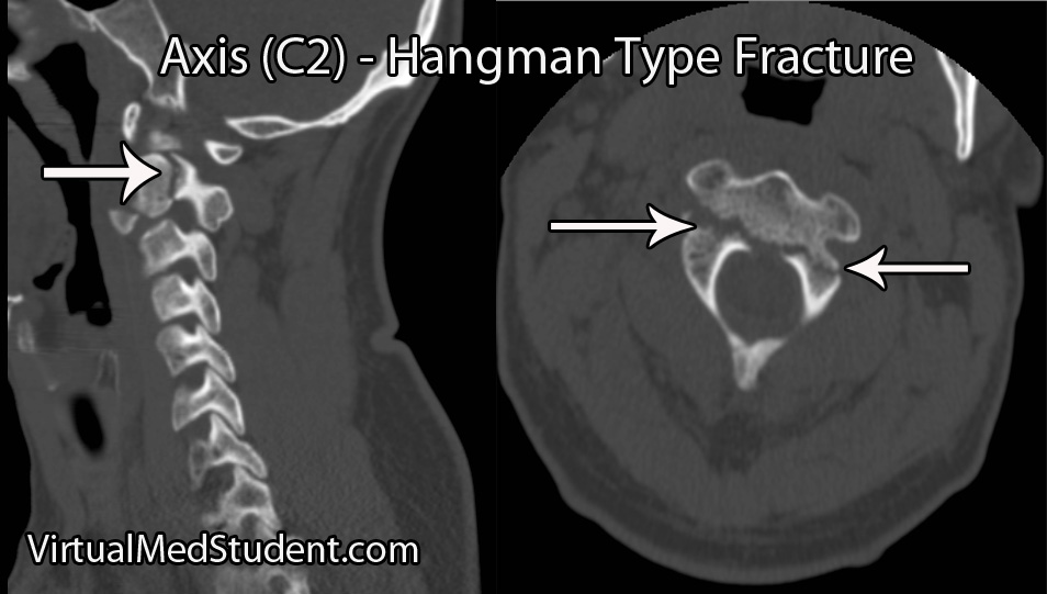 Hangman's fracture