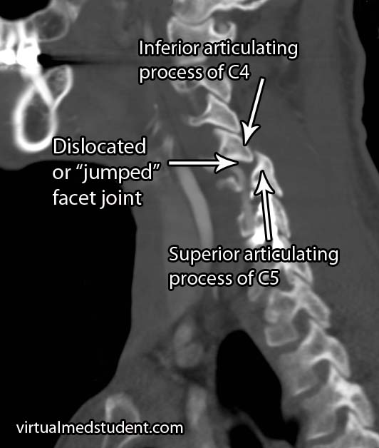 Dislocated Facet