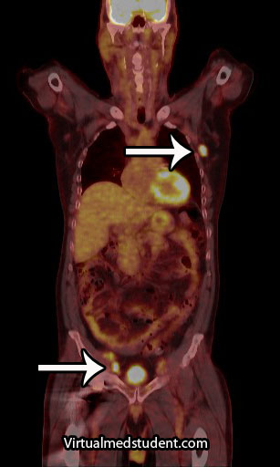 Hodgkin's Disease PET-CT