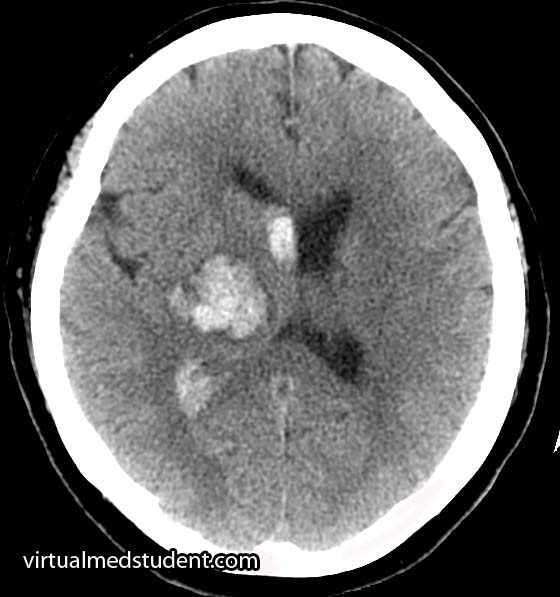 Thalamic Haemorrhage