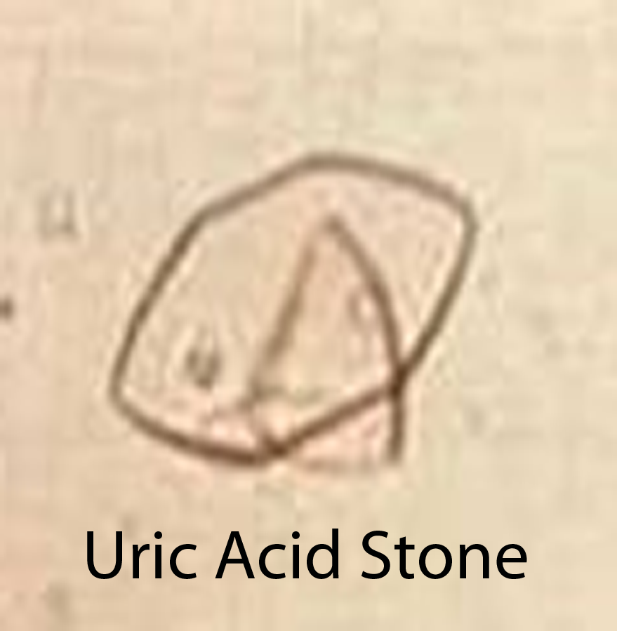 Home & Herbal Remedies for Increased Uric Acid Level (Gout)