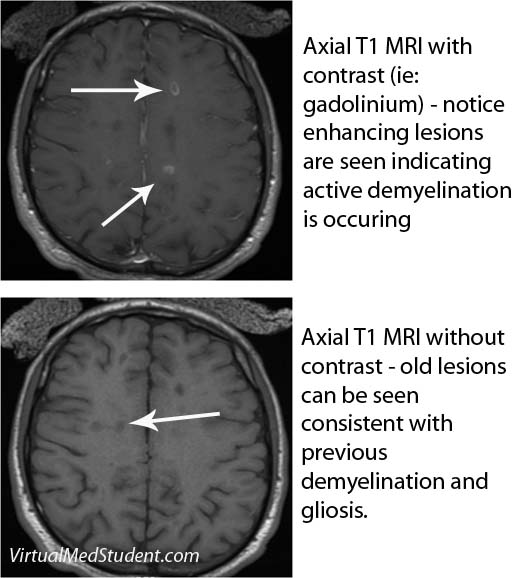 MRI of Multiple Sclerosis