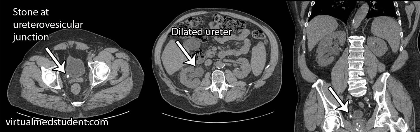 CT of Kidney Stones