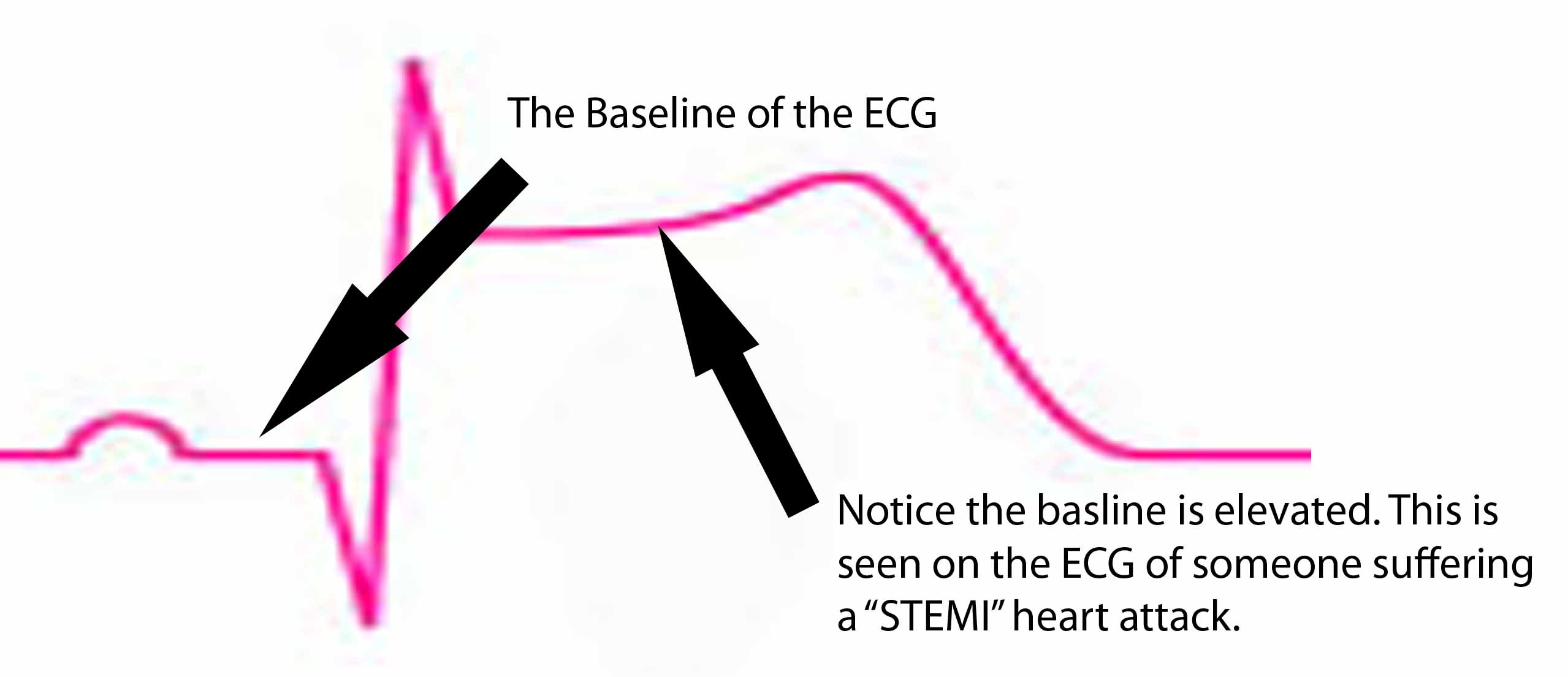 St Segment
