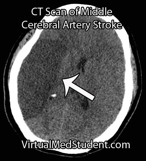 MCA Stroke CT Scan