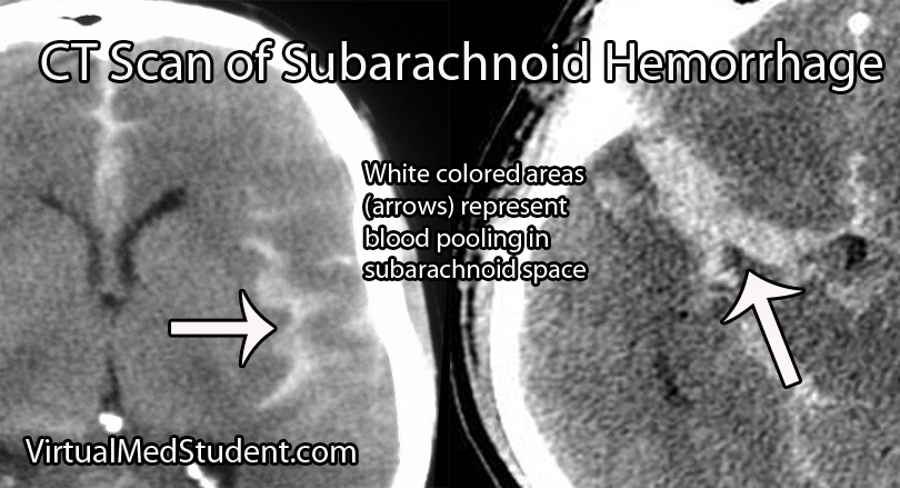Subarachnoid Bleed Ct