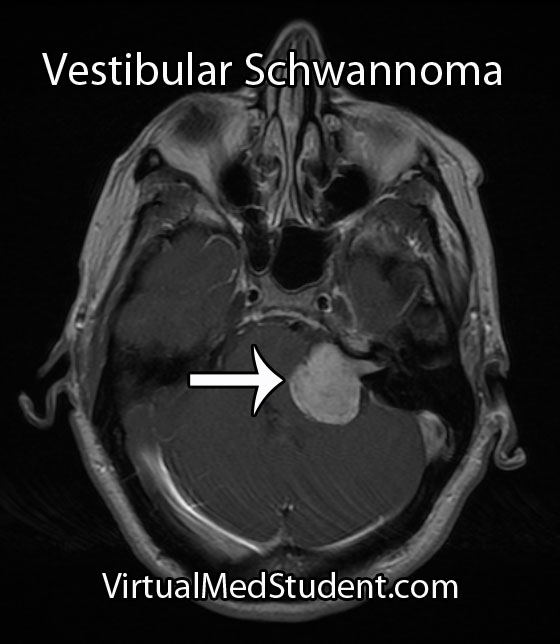 Vestibular Schwannoma