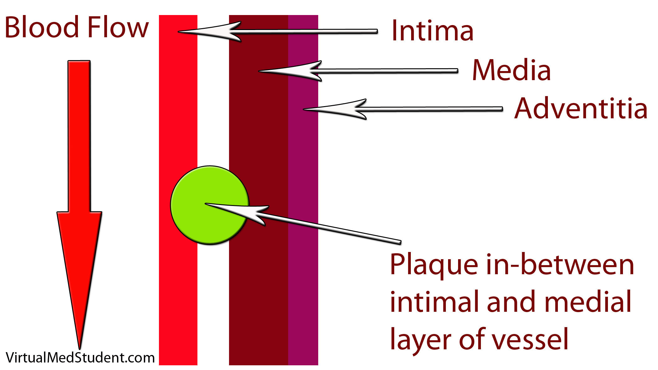 Blood Vessel with Plaque