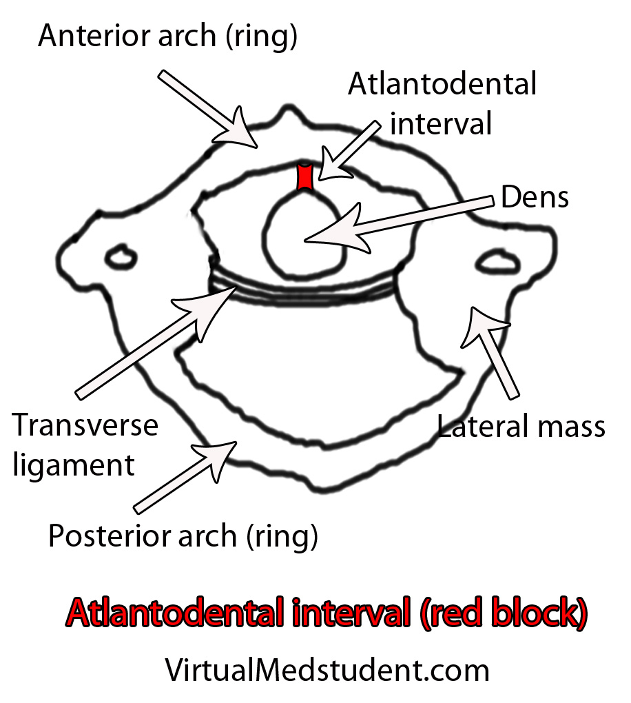 Atlantodental Interval