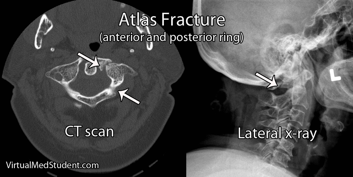Atlas fracture