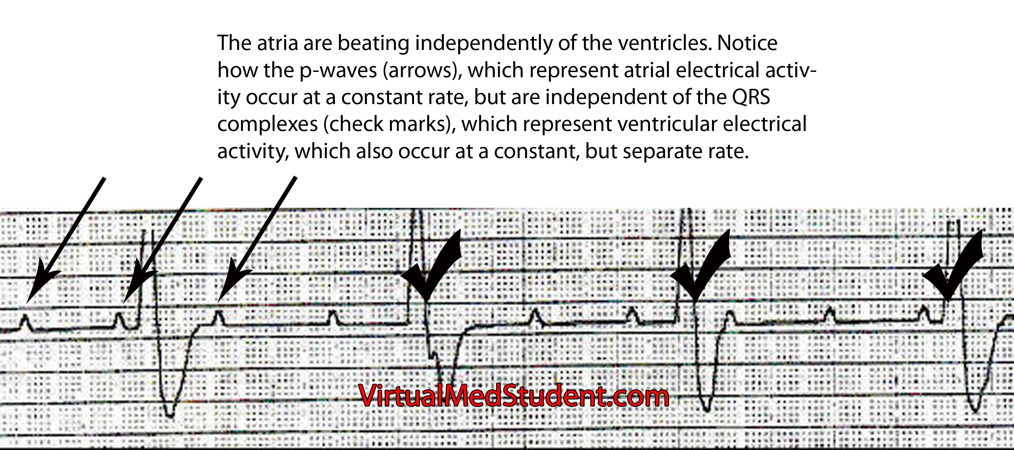 AV nodal block type 3