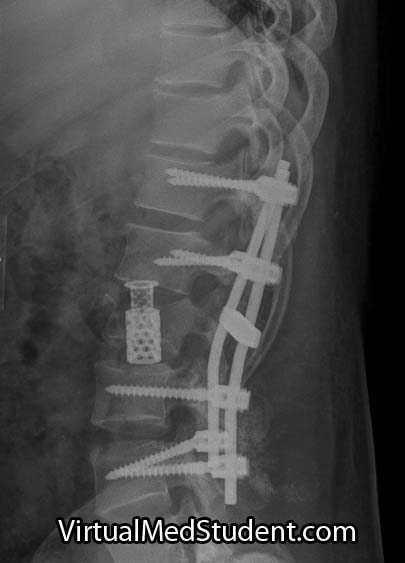 Burst fracture after instrumentation