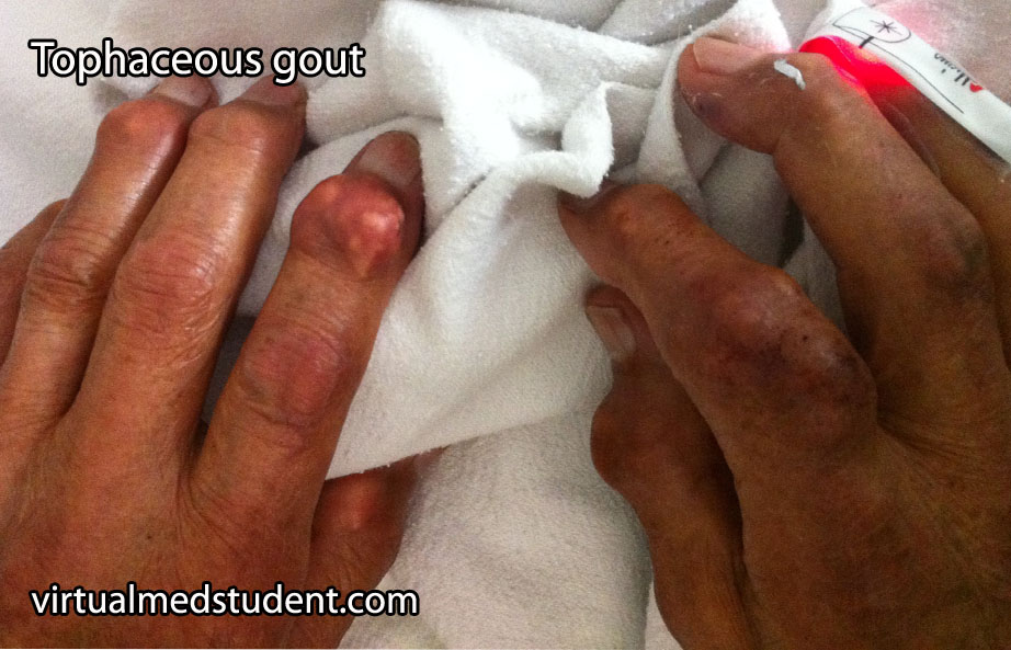 Tophaceous Gout