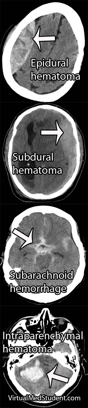 CT scans of Intracerebral Hemorrhages